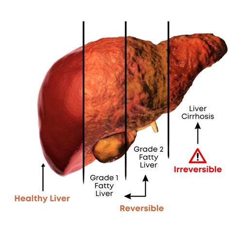 Fat to Fit Liver, Naturally Free Masterclass