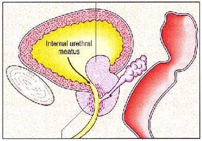 Ramayya Pramila Urology Hospital: The prostatic enlargement:Everthing ...