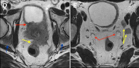 Prostate cancer - MRI - Radiology at St. Vincent's University Hospital