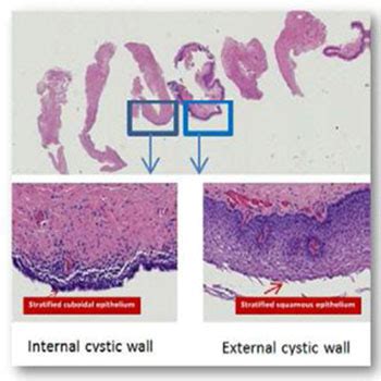 Marsupialization of Skene’s Gland Cyst