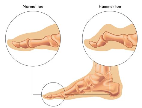 Hammertoe Treatment | Artesia, CA | My Foot Clinic