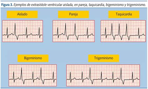 BIGEMINISMO VENTRICULAR PDF