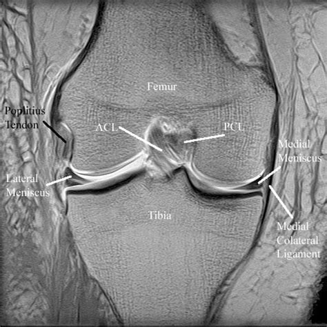 Magnetic Resonance Imaging (MRI) - Specialist Knee Surgeon in ...