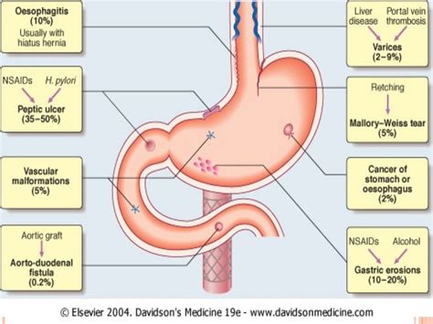 Upper Gastrointestinal bleeding