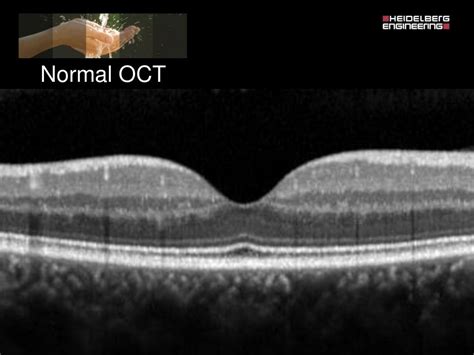 Spectralis oct normal anatomy & systematic interpretation.