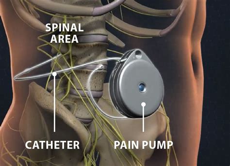 What is a Pain Pump?