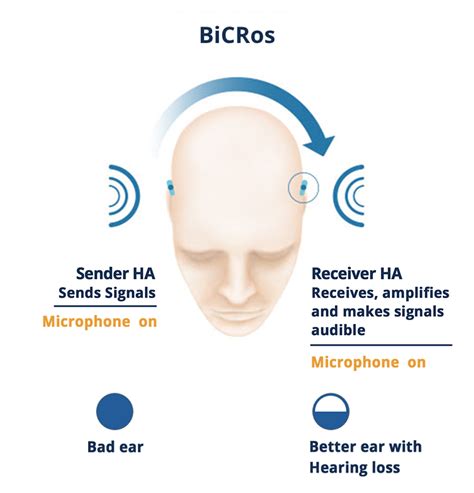 CROS- and BiCROS-Technology: Find all information here! | hear.com IN