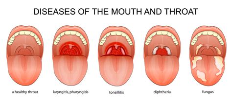 Medical problems of the eyes, ears, nose, and throat: Glaucoma symptoms ...