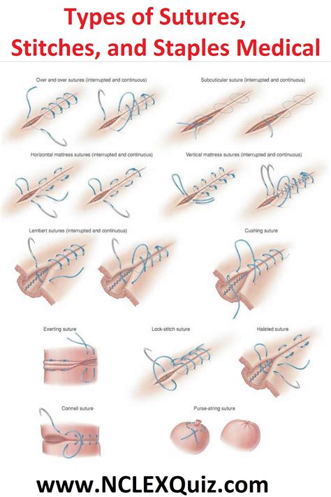 Types of Sutures, Stitches, and Staples Medical - NCLEX Quiz