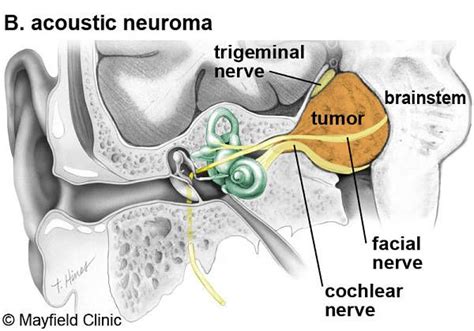 Image result for acoustic neuroma | Nervio facial, Nervio, Acústico