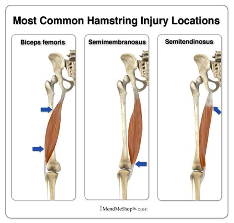 Proximal Hamstring Tendon Rupture