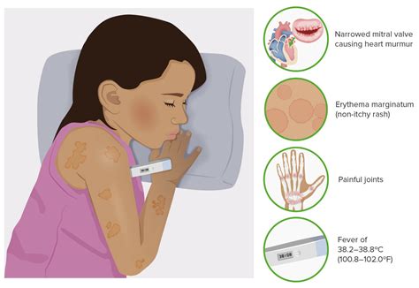 Rheumatic Fever | Concise Medical Knowledge