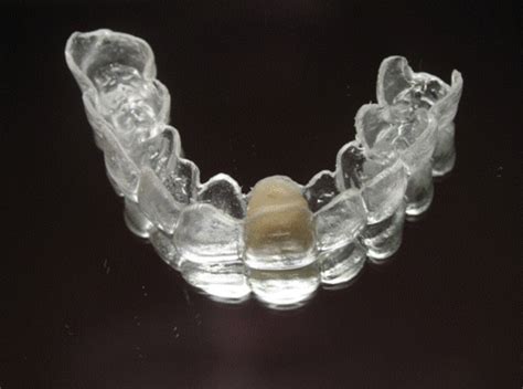 Clear Essix Pontic Retainer – Digital Dental Prosthetics