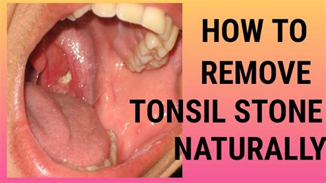 Tonsil stone remedy forever | How to remove tonsil stone naturally ...