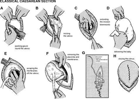 How to Perform a Classical Caesarean Section | Caesarean section, C ...