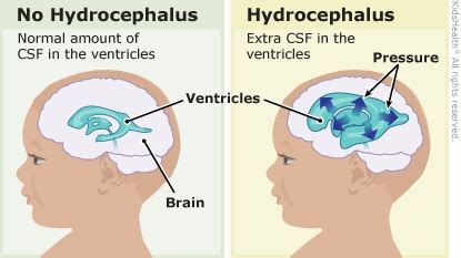 Hydrocephalus | Rady Children's Hospital