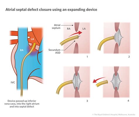 Cardiology : Atrial Septal Defect