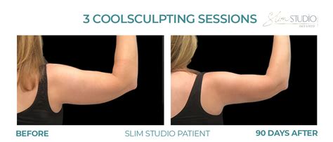 Body Sculpting Before and After Gallery | Slim Studio Atlanta