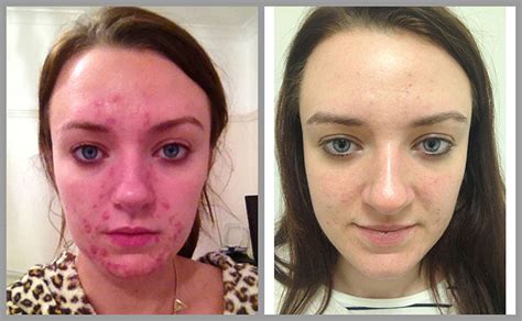 Acne Laser Treatment Pros and Cons, Best Acne Treatment to Get Rid of Acne