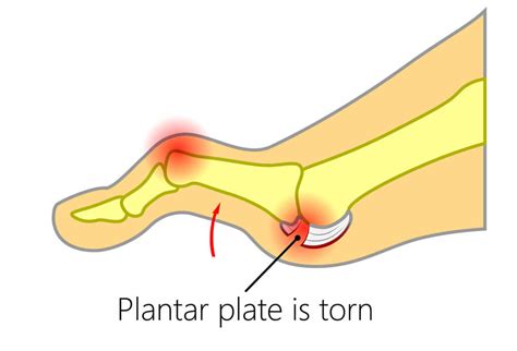 Podiatry Centre for Plantar Plate Tear in Singapore