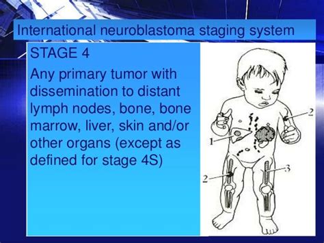 Neuroblastoma