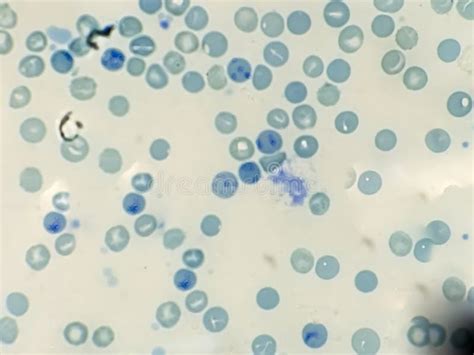 Reticulocyte Count from Blood Smear Hematology. Stock Photo - Image of ...