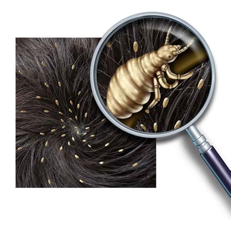 Types Of Lice And Common Head Lice Symptoms - Lice Clinics of America