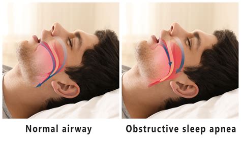 Obstructive Sleep Apnea Treatments to Reduce Cardiovascular Disease ...