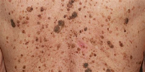 Got Mystery, Wart-Like Growths? They May Be Seborrheic Keratoses! - Dr ...