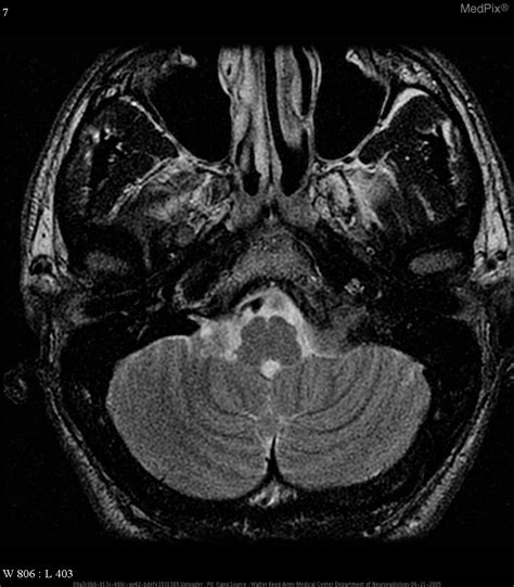 Jugular Foramen Mri