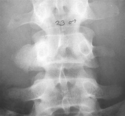 Osteoblastoma os the spine affects the neural arch Musculoskeletal ...