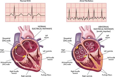 Atrial Fibrillation: Causes, Symptoms, and Advanced Treatments ...