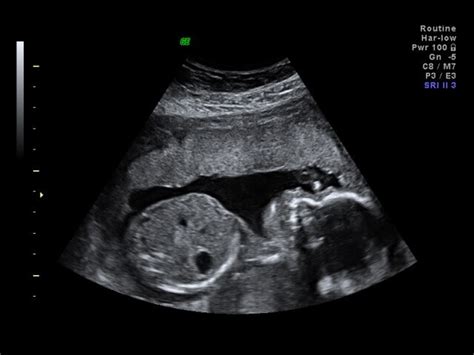 Private Anomaly Scans in the UK | Ultrasound Plus