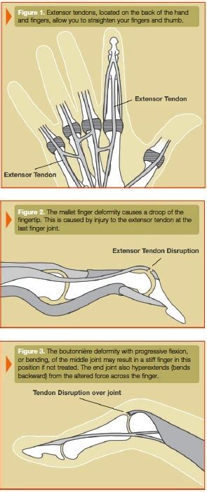 Extensor Tendon Injuries New York - The New York Hand & Wrist Center