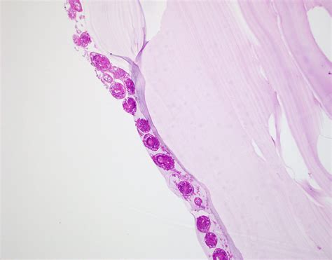 Hydatid Cyst Structure