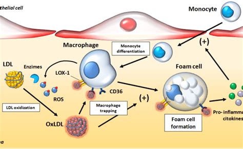 Atherosclerosis Pathogenesis Ldl Oxidation Macrophage Scavenger ...