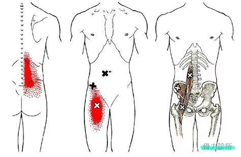 腹股沟痛伴随腰痛，你的髂腰肌太紧张了…-搜狐大视野-搜狐新闻