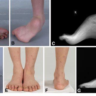 A–G A 10-year-old boy with spastic cerebral palsy, hemiplegic type, who ...