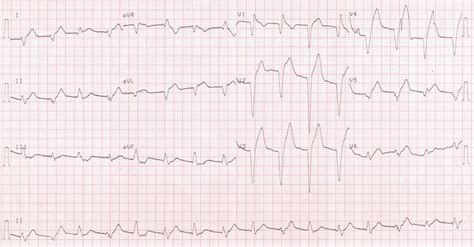 What is the treatment of idioventricular rhythm? – All About ...