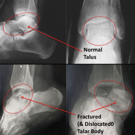 Talar Body Fracture - FootEducation