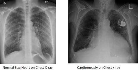 Chest Xray Heart