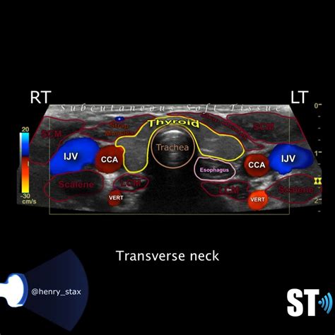 Thyroid Ultrasound Protocol – Sonographic Tendencies