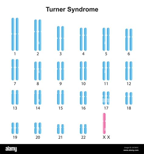 Karyotype of turner syndrome hi-res stock photography and images - Alamy