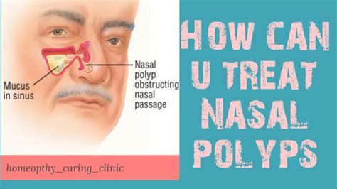 Nasal Polyps Anatomy