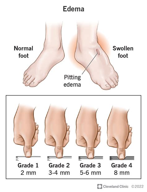 How To Keep Ankles From Swelling - Aimsnow7