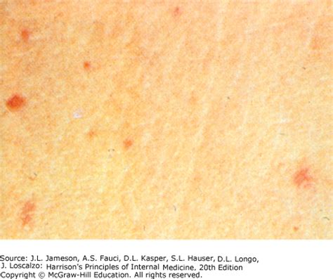 Salmonella Typhi Rash - bmp-leg