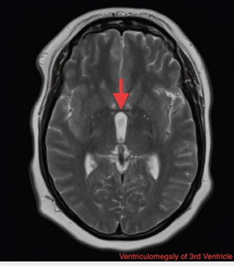 Mri Brain Ventricle Anatomy