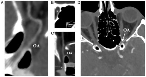 Curved multiplanar reconstruction images displaying the ICA and the OA ...