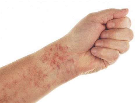 Petechiae: Causes, Treatments, Pictures, and More