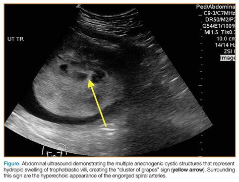 Molar Pregnancy Symptoms 5 Weeks - pregnancysymptoms